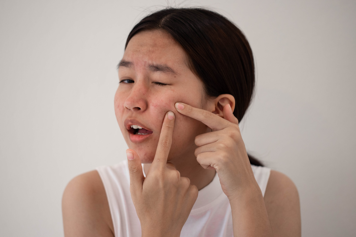 Acne Marks vs Acne Scars: Post-Inflammatory Hyperpigmentation (PIH) Explained & How to Fade It