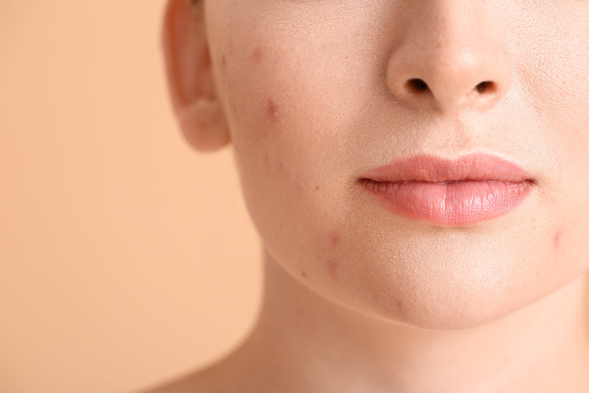 Woman with acne-prone skin