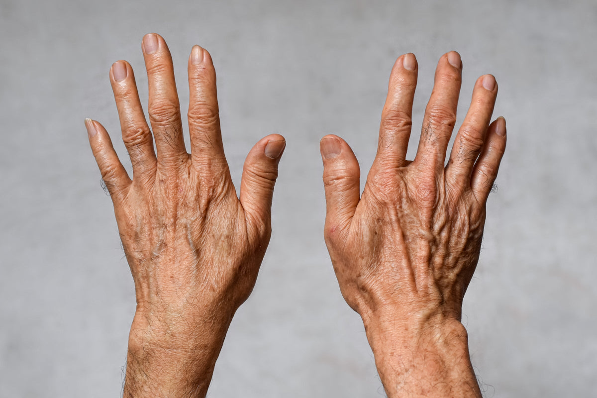 Age Spots on Hands: Why Hands Show Damage First, How to Fade & Prevent