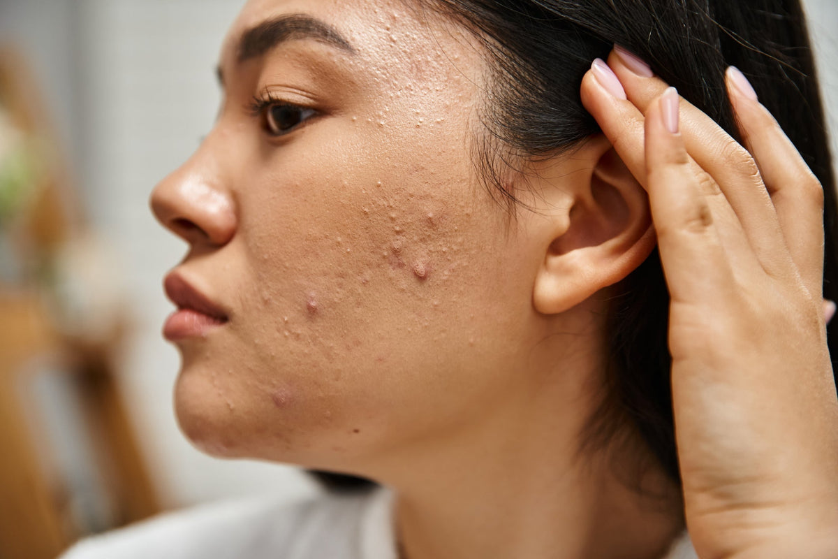 Acne Explained: What Causes Acne, How to Treat Acne, and the Truth About Clearer Skin