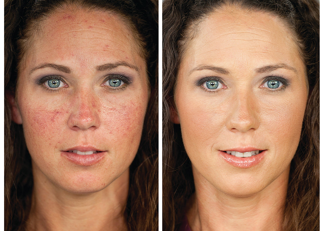 More Than Skin Deep: The Emotional Effects of Biotin Rosacea