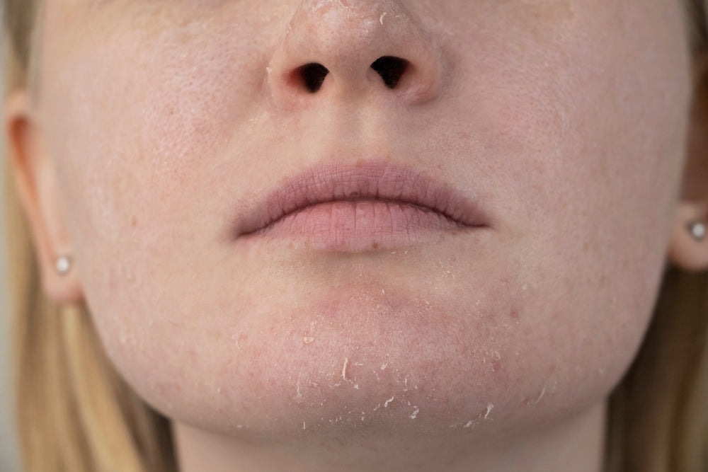 Closeup image of the lower half of a white woman’s face with dry, peeling skin on her chin.