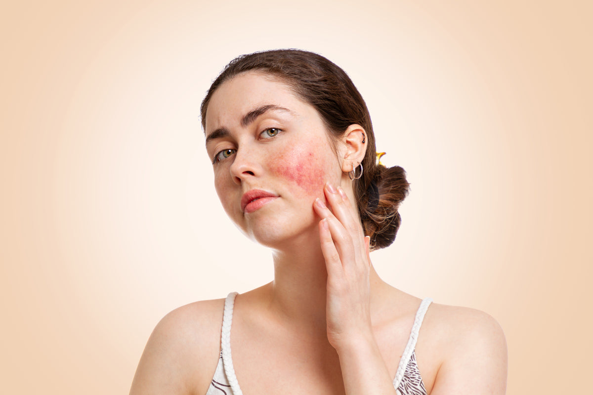 Understanding and Addressing Rosacea - By Dr. Sandy Johnson, Board Certified Dermatologist