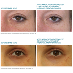 unretouched before and after images after using Total Eye Hydrogel Treatment Masks and Concentrate Serum || all