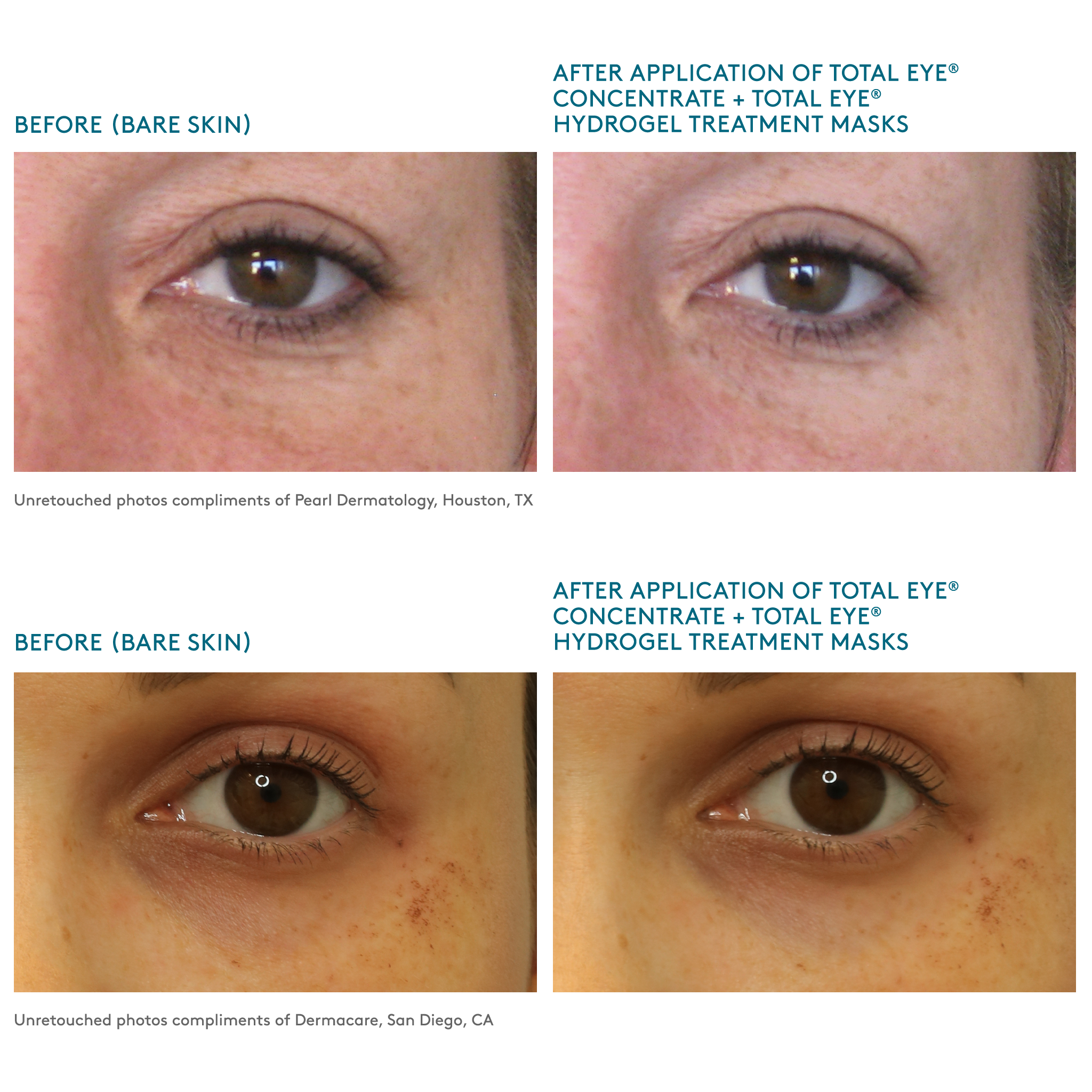 unretouched before and after images after using Total Eye Hydrogel Treatment Masks and Concentrate Serum || all