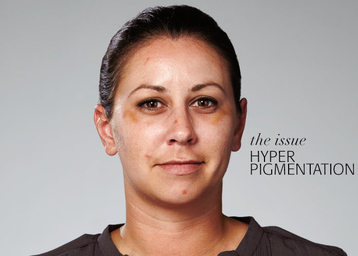 Hyperpigmentation 101
