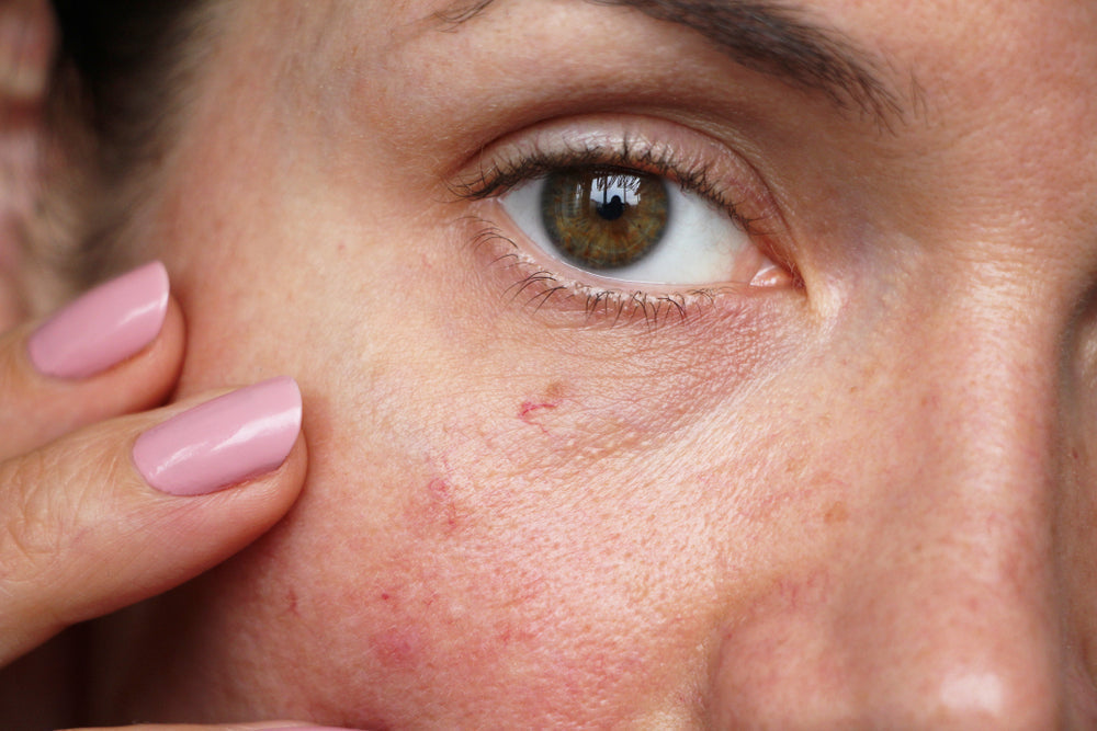 face-redness