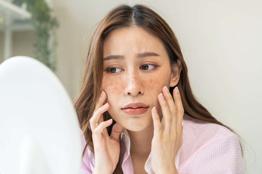 Young Asian woman looking at skin hyperpigmentation in a magnifying mirror.
