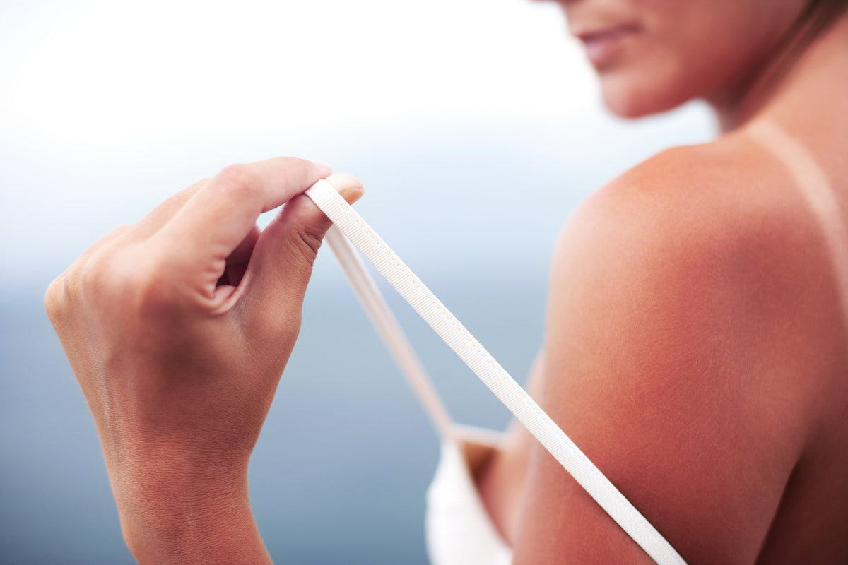 sunburnt woman in need of home remedies for sunburn relief