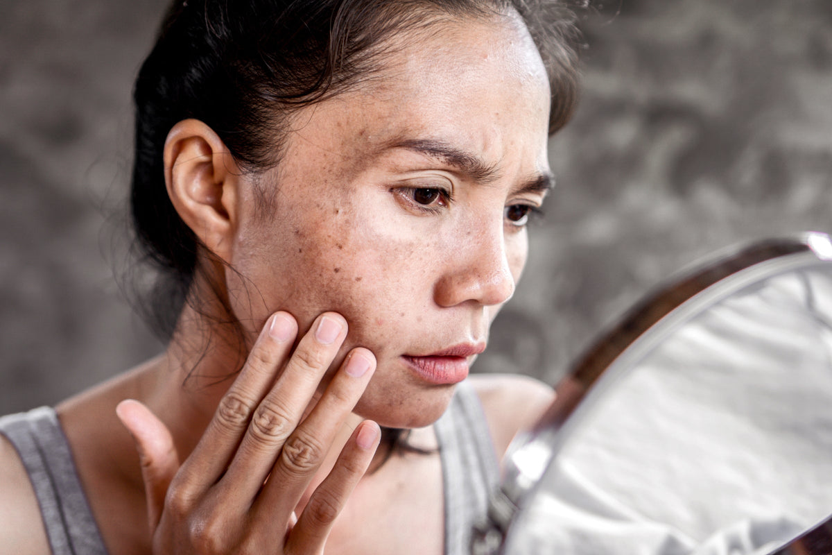 Melasma vs. Hyperpigmentation: How to Tell Which You Have