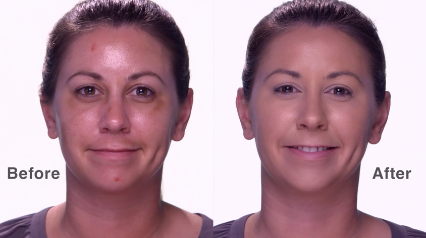 Update: Melanie’s Hyperpigmentation Results