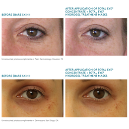 unretouched before and after images after using Total Eye Hydrogel Treatment Masks and Concentrate Serum