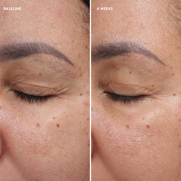 before and after of woman's eyes at baseline and week 8