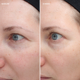 before and after of woman's eyes at baseline and week 8